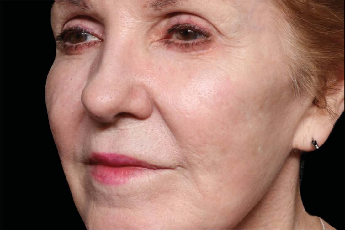 Скули и долна част на лицето — след