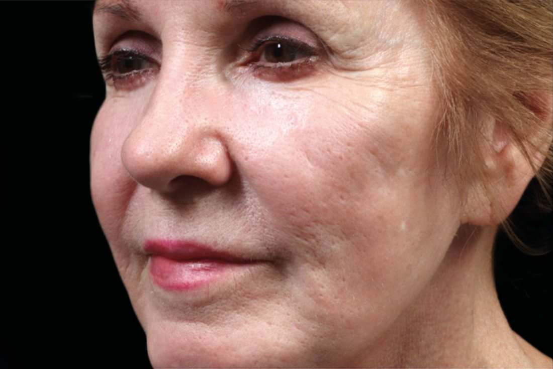 Скули и долна част на лицето — преди